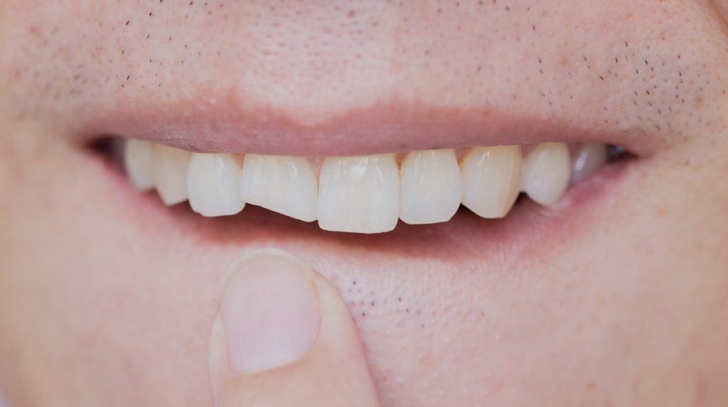 crack in tooth