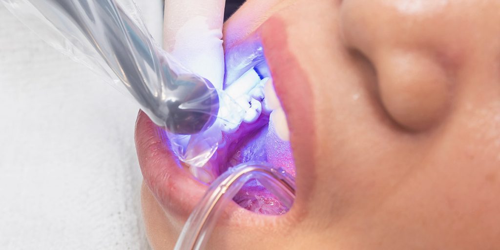 Dentists doing composite bonding process and the composite bonding consultation