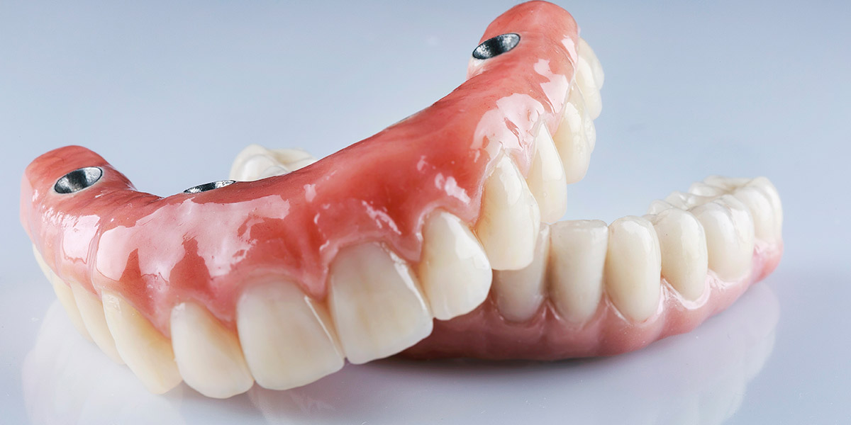 All on 4 dental implants