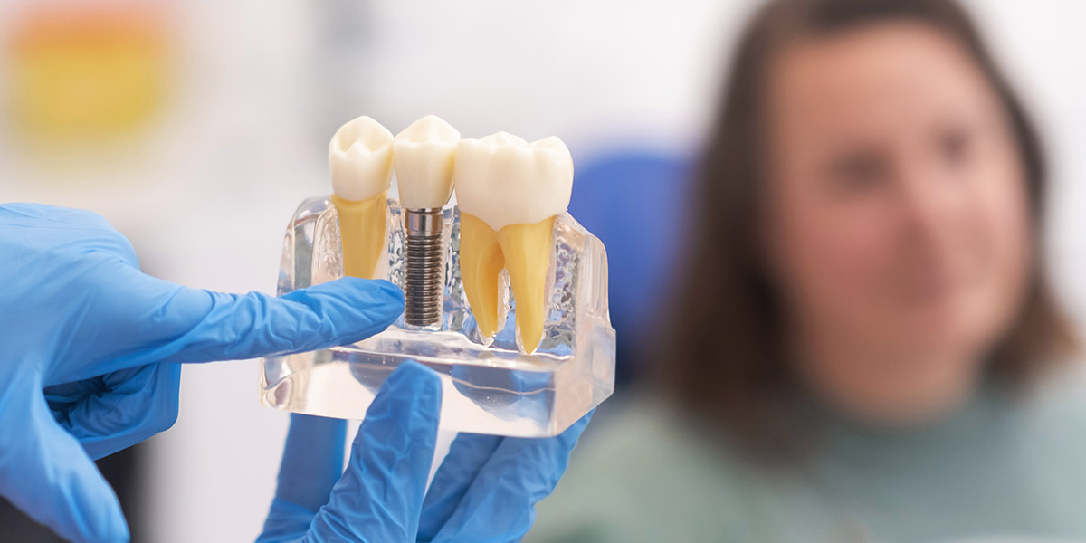 best dental implants