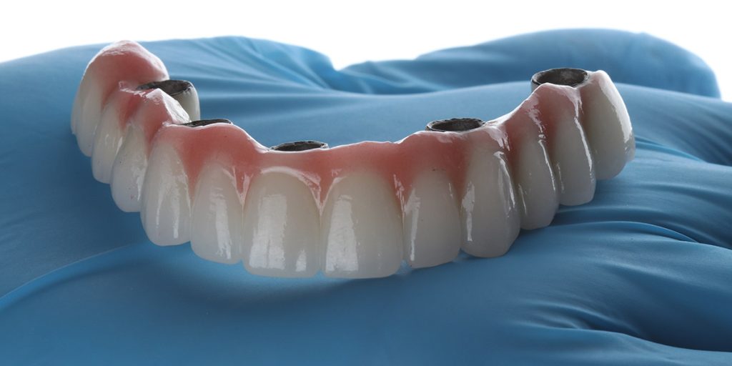 dentists hand holding up full arch dental implants