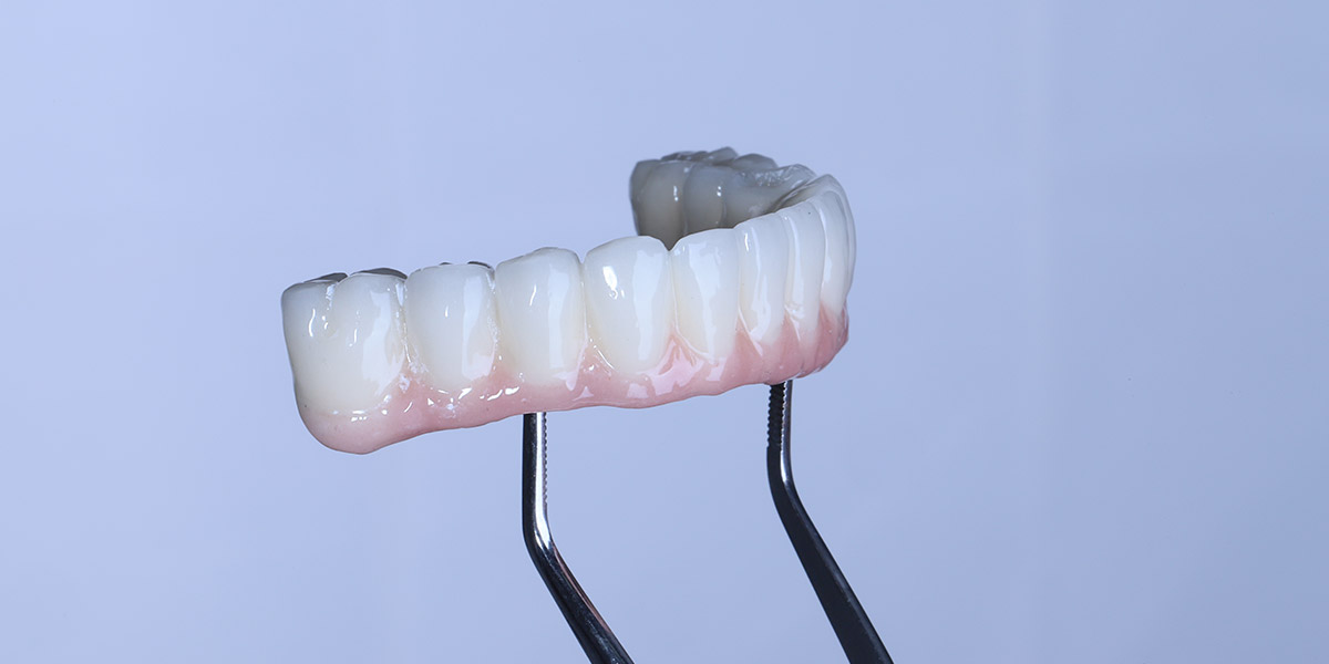 full arch dental implants