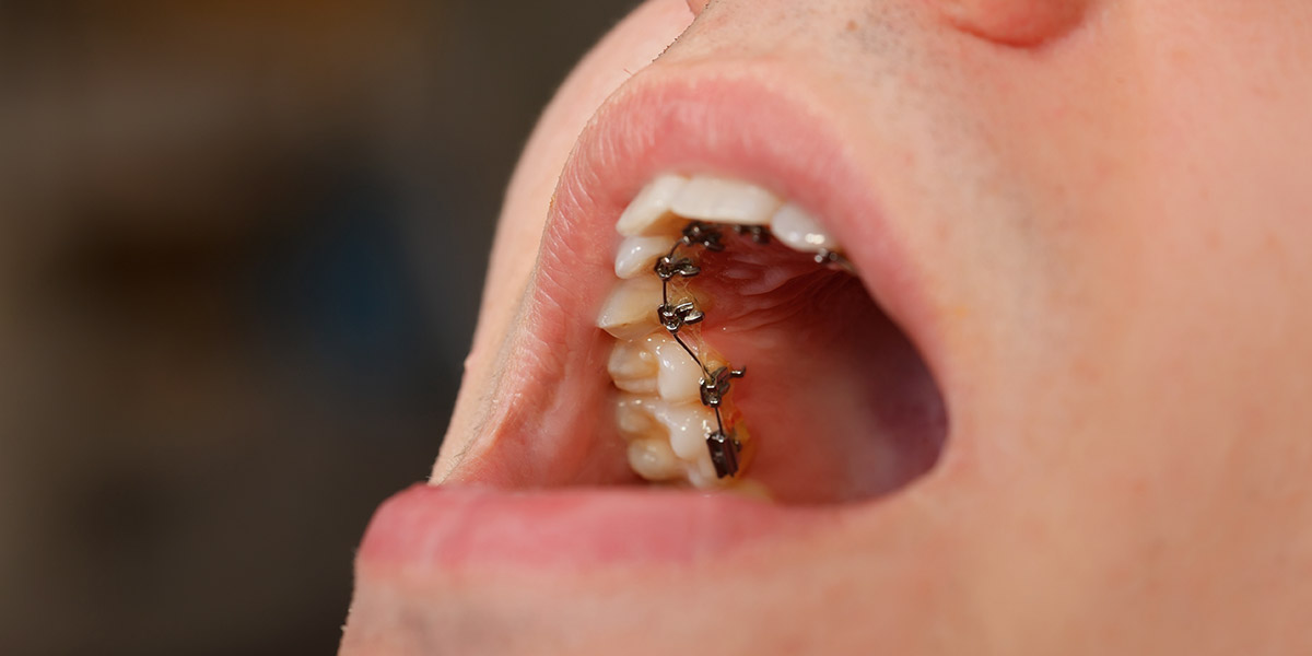 lingual braces technology