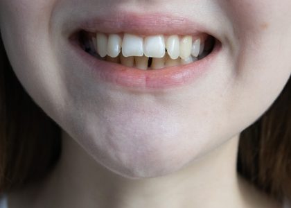 How to fix overbite