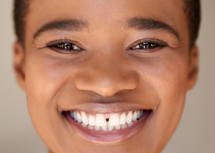 gaps between teeth